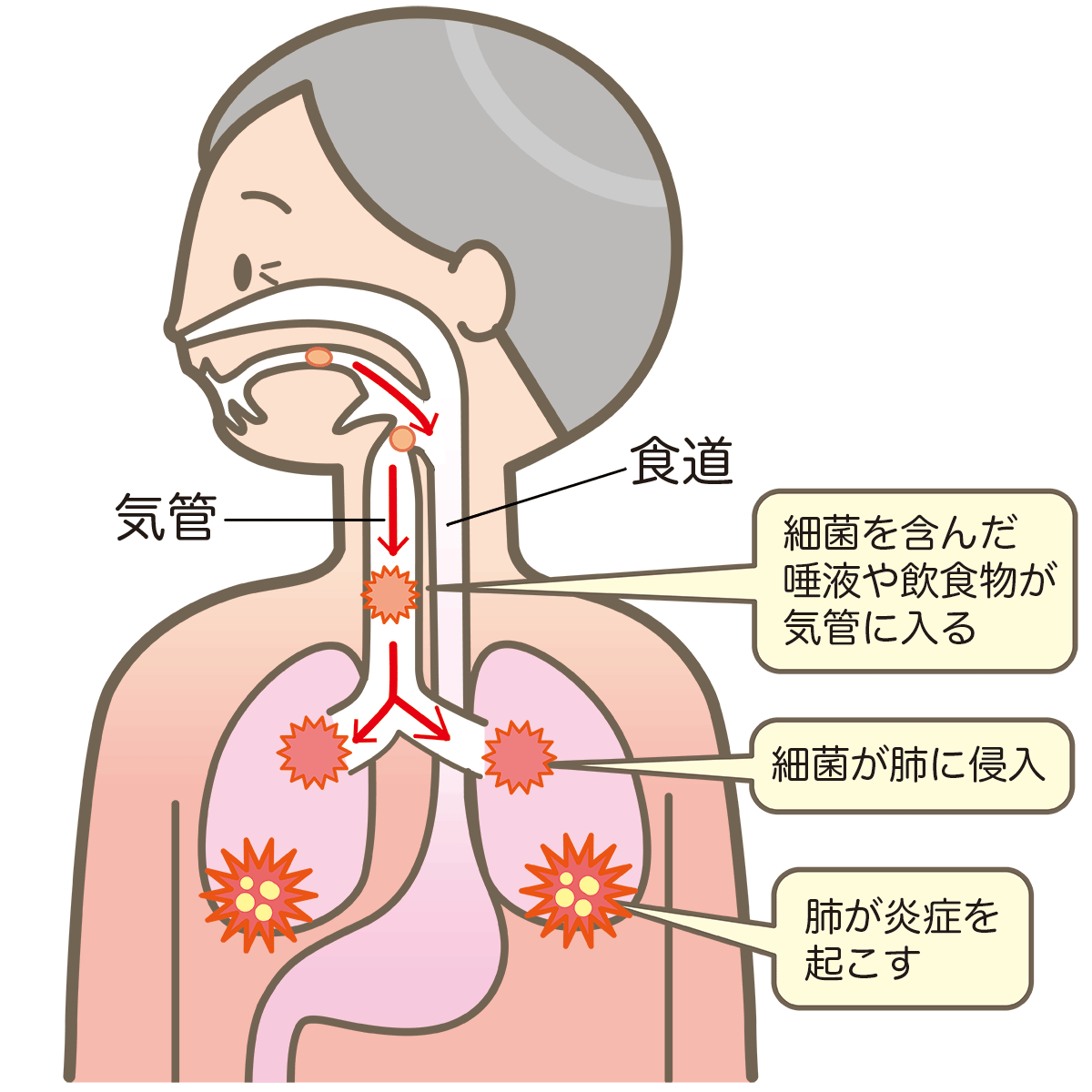 誤嚥性肺炎 イメージ図